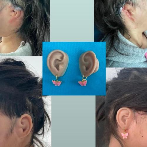 Reconstrucción de la oreja Fotos del antes y el después